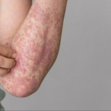 Ternyata Gejala Campak ini yang Dialami Dokter AMW sebelum Meninggal, Jika Anda Mengalami Langsung ke Dokter!