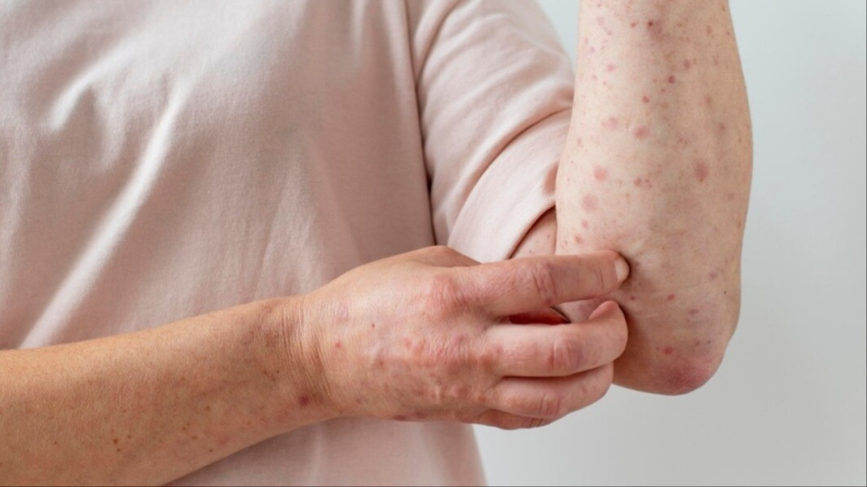 Ramai soal Dokter Meninggal karena Campak, Praktisi Kesehatan Ingatkan Vaksin itu Aman dan Halal
            - galeri foto