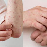 Hati-hati! Empat Daerah di Sumatra Selatan Ditetapkan sebagai KLB Campak