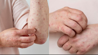 Hati-hati! Empat Daerah di Sumatra Selatan Ditetapkan sebagai KLB Campak