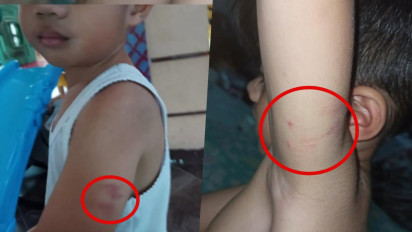Orang Tua Korban Daycare Little Aresha Curiga Usai Temukan Banyak Luka Misterius di Punggung Anak