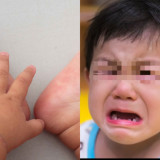 Flu Singapura Merebak di Sumatra Selatan, Mengapa Banyak Menjangkit Anak-anak?