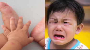 Flu Singapura Merebak di Sumatra Selatan, Mengapa Banyak Menjangkit Anak-anak?