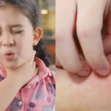 Praktisi Kesehatan Masyarakat Ingatkan Flu Singapura Biasa Menular di Sekolah, Waspada tapi Tidak Perlu Panik