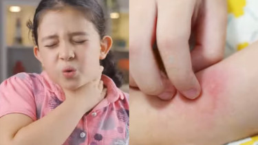 Praktisi Kesehatan Masyarakat Ingatkan Flu Singapura Biasa Menular di Sekolah, Waspada tapi Tidak Perlu Panik