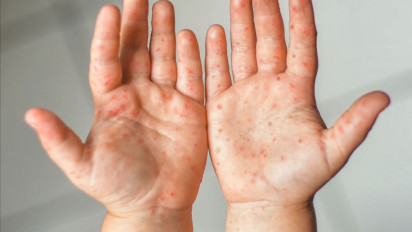 Ternyata Ini Alasan Ratusan Kasus Flu Singapura Ditemukan di Sumsel