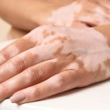 Mengenal Vitiligo, Penyakit Kulit yang Tak Menular tetapi Berdampak pada Mental