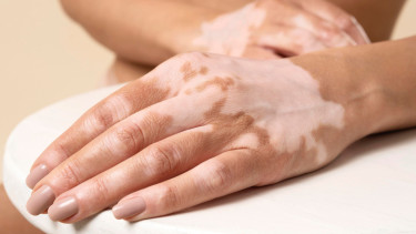 Mengenal Vitiligo, Penyakit Kulit yang Tak Menular tetapi Berdampak pada Mental