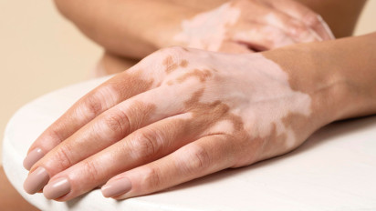 Mengenal Vitiligo, Penyakit Kulit yang Tak Menular tetapi Berdampak pada Mental
