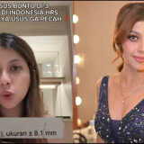 Siapa Fahira Almira? Selebgram Adik Sarah Keihl yang Viral soal Dugaan Salah Diagnosis Usus Buntu