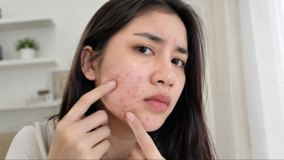 Apa Benar Jangan Pakai Sunscreen saat Jerawatan? Ini Jawaban Dokter