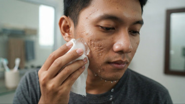 Benarkah Bopeng Bisa Hilang Pakai Es Batu? Ini Penjelasan Dokter Kecantikan